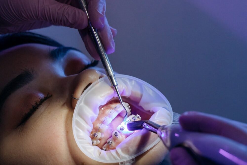 Blanchiment dentaire